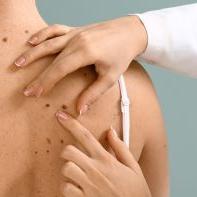 Znamiona pod kontrolą – wideodermatoskopia
