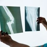 Standing X-ray of the Lower Limbs